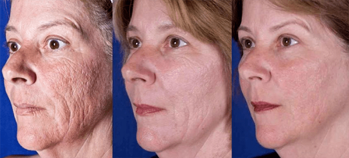 The result after the laser facial rejuvenation procedure