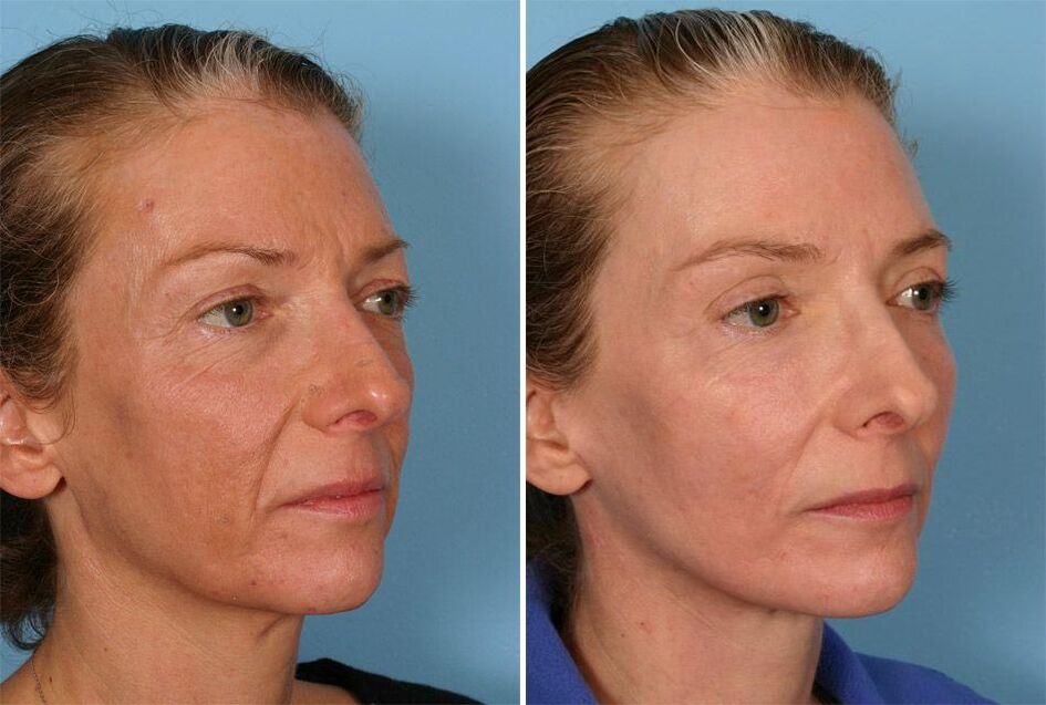 before and after laser rejuvenation